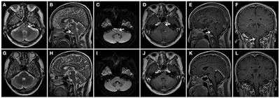 Case Report: Repeated Low-Dose Rituximab Treatment Is Effective in Relapsing Neuro Behçet's Disease